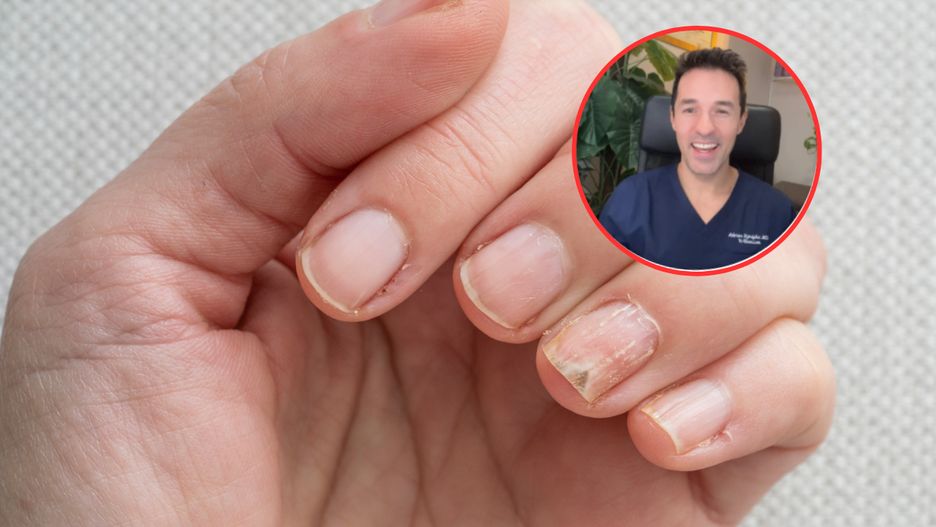 Paznokcie mogą niekiedy wskazywać na chorobę