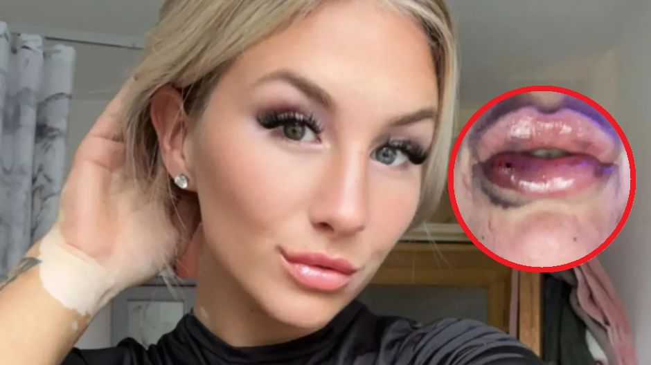 Chciała zaoszczędzić. Tak wyglądają jej usta