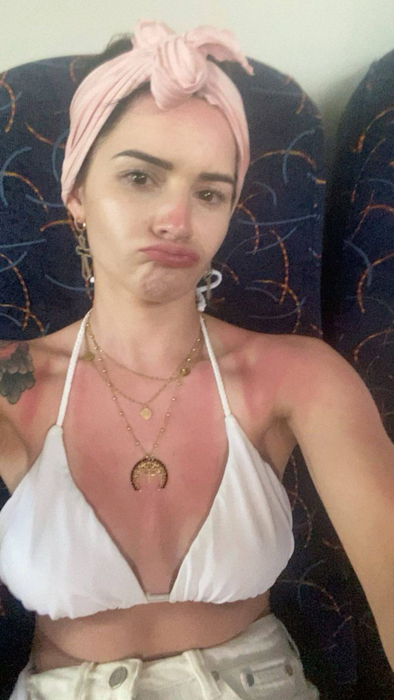 Ewelina Lisowska poparzyła się na wakacjach
