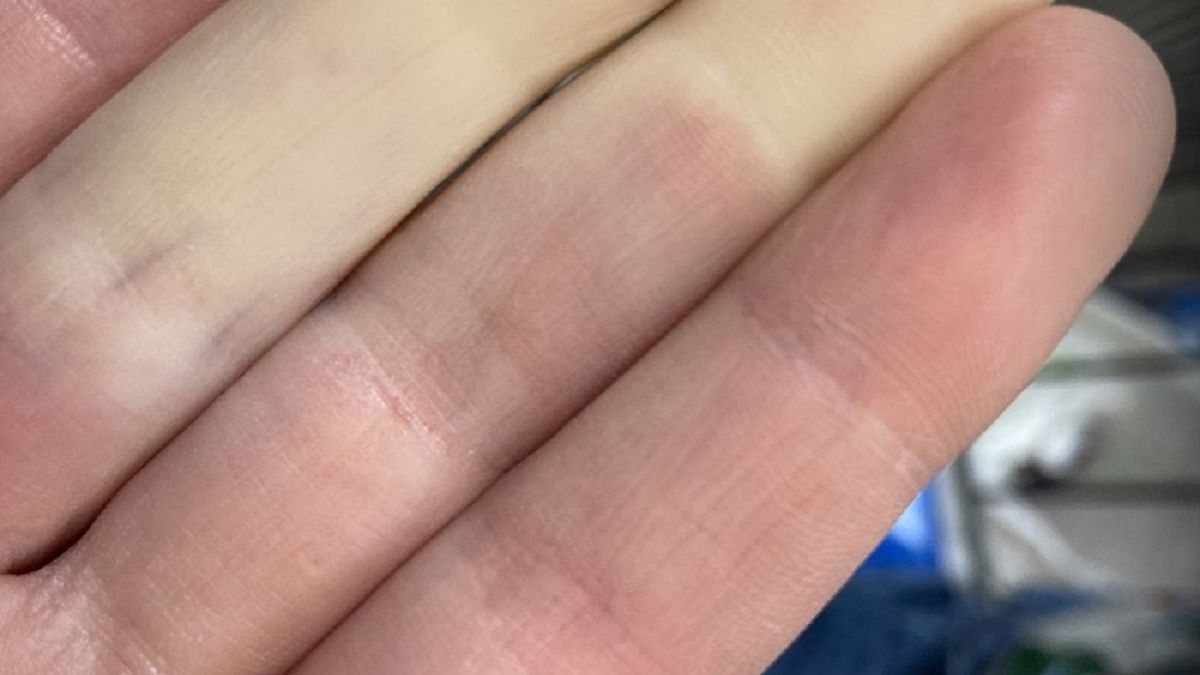 Objawy chorobyą Raynauda widać na dłoniach