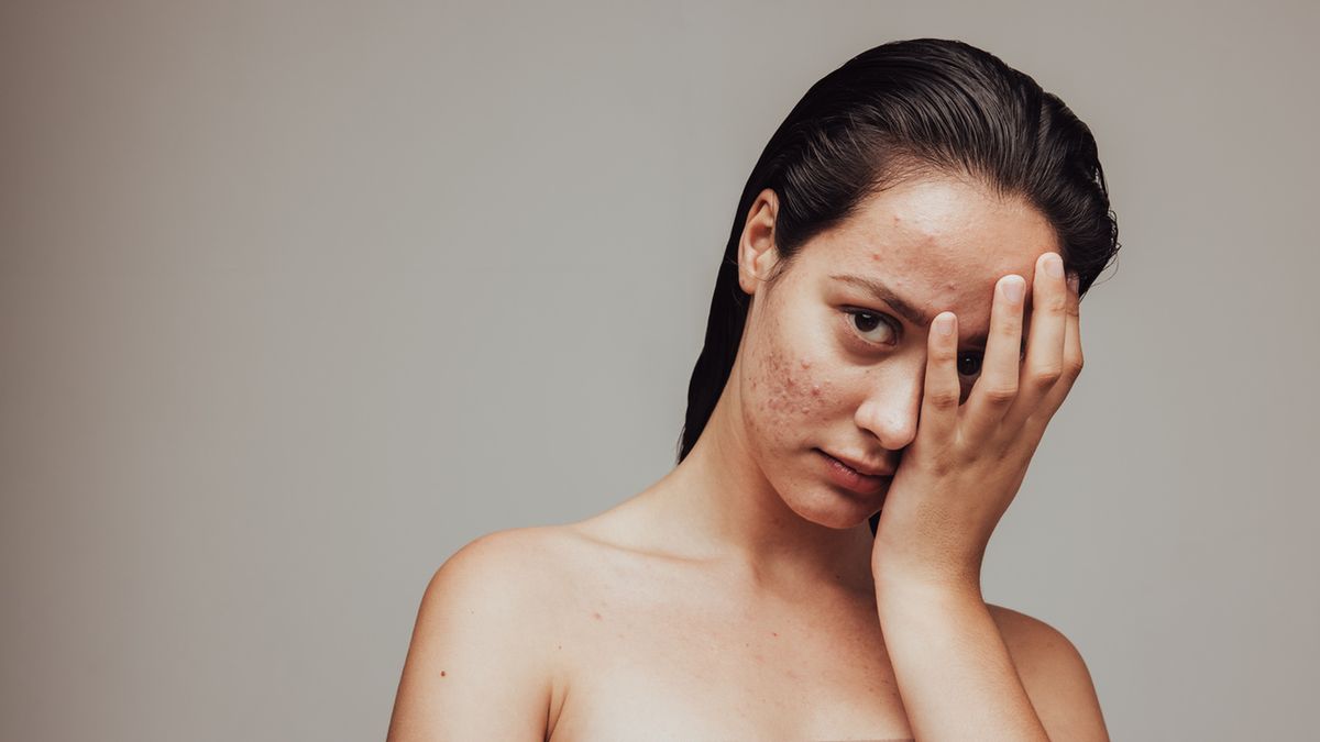 Davercin to lek, który stosowany jest w leczeniu trądziku pospolitego. Davercin występuje w postaci płynu, który nanosi się na skórę. a także w postaci tabletek powlekanych.