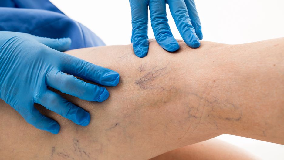 teleangiektazje, choroby skóry, żylaki, zakrzepica, owrzodzenie żylne, medycyna estetyczna, laseroterapia, fototerapia, teleangiektazja, zmiany naczyniowe, dermatologia