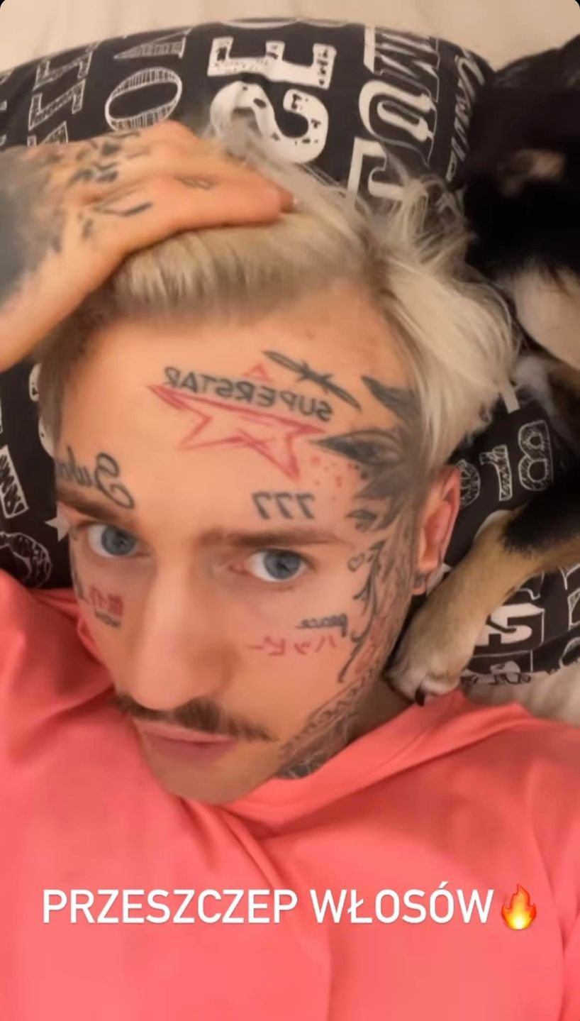 Stifler prezentuje efekty przeszczepu włosów