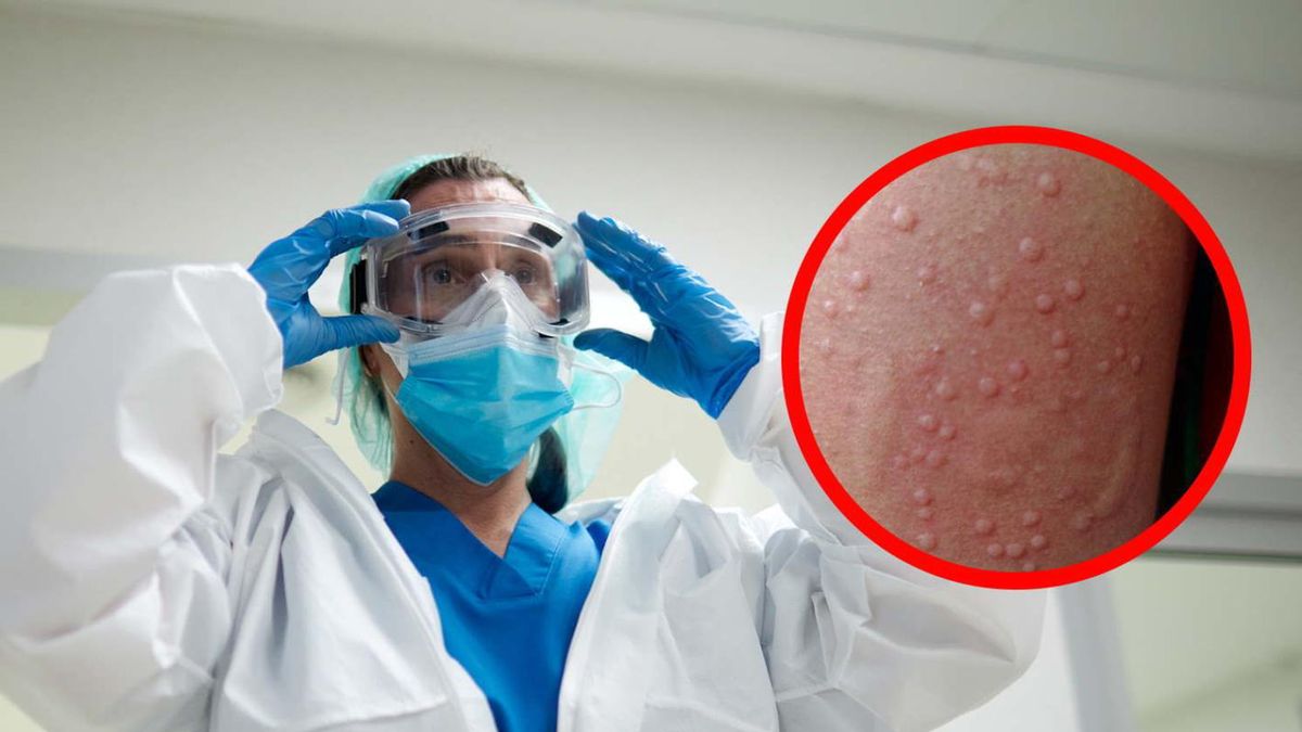 Egzotyczny wirus już za Odrą. Wykryto pierwszy przypadek