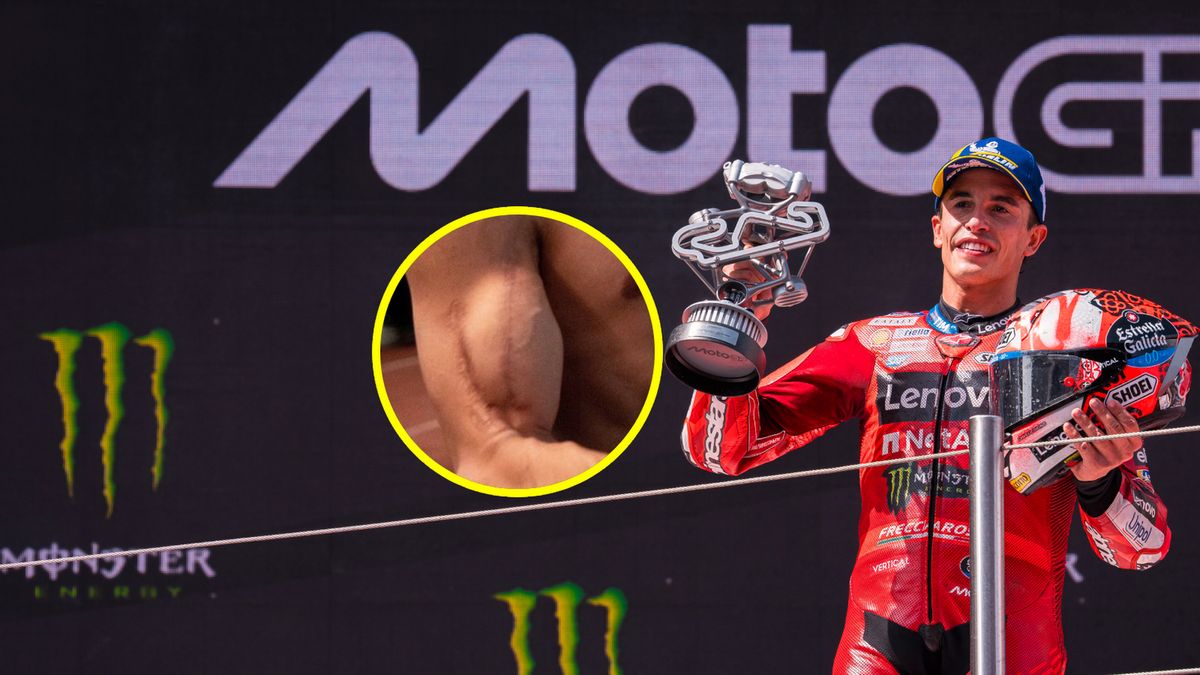 Materiały prasowe / Monster Media / Vaclav Duska / Instagram / Na zdjęciu: Marc Marquez, w kółku kontuzjowana ręka Hiszpana