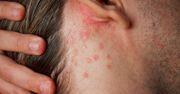 Zaczyna się od "zwykłej" wysypki. Znak, że zaatakował groźny nowotwór