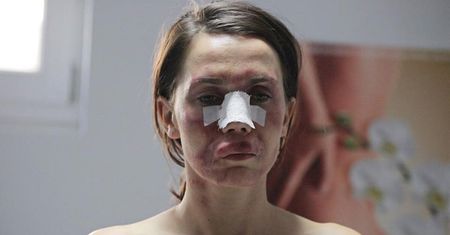 Co o "Botoksie" sądzą lekarze? Sprawdziliśmy