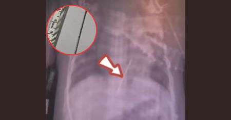 Lekarze zamarli, gdy zobaczyli zdjęcie. Igła wbiła się dziecku w serce