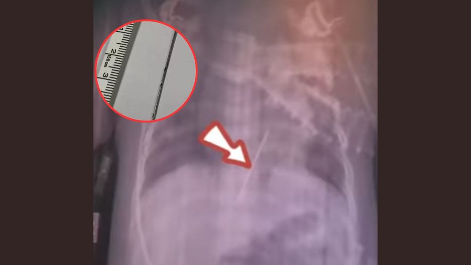 Dziecko połknęło igłę