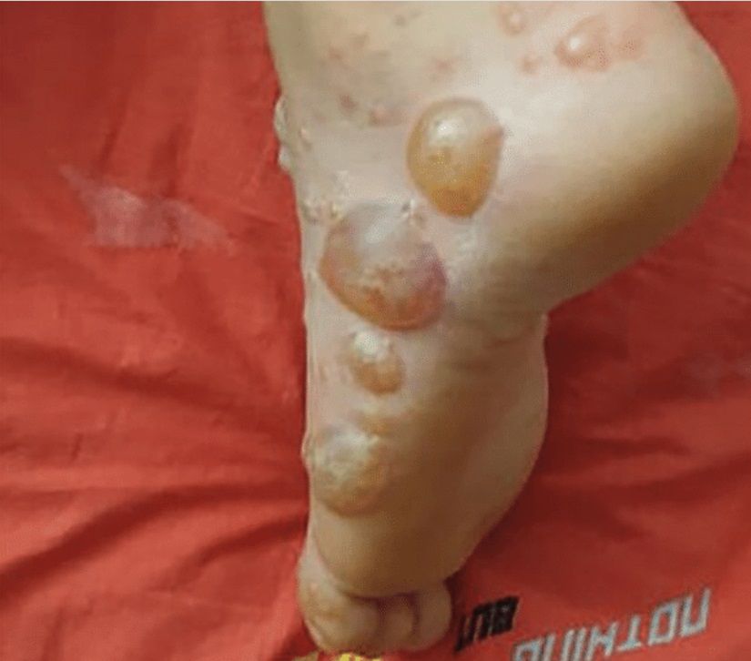 Grudkowo-pęcherzykowe zmiany związane z COVID-19