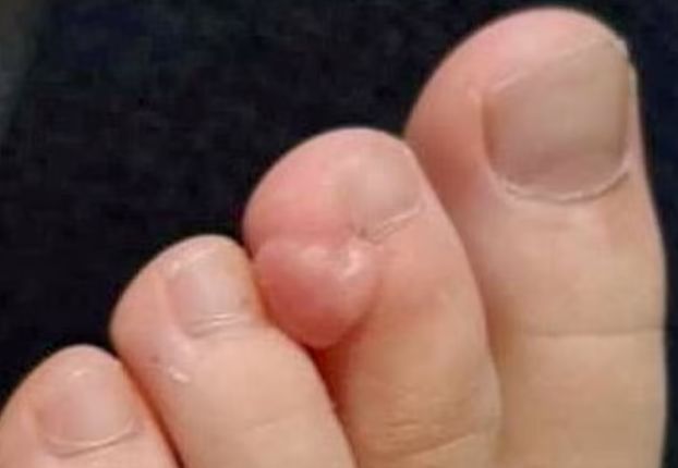 Zaczęło się od pozornie niewinnego guza