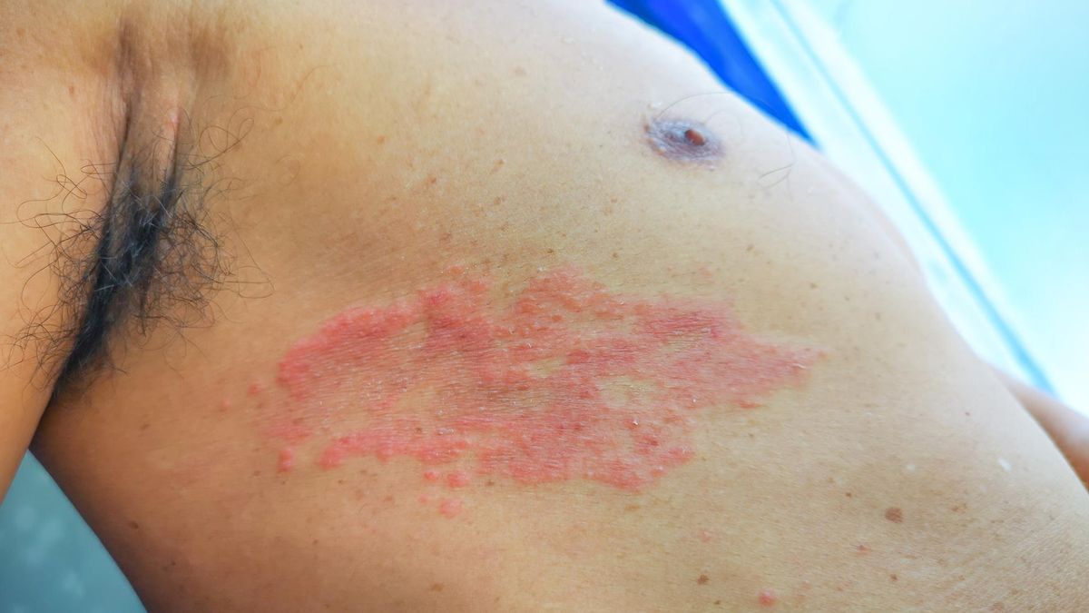 Małpia ospa wróciła do Europy. Uważaj podczas urlopu