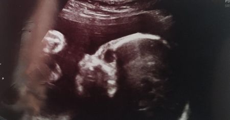 Lekarze namawiali ją do aborcji. Urodziła dziecko z zespołem Edwardsa