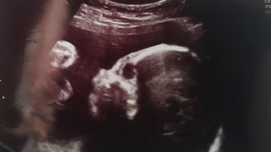 Płód z zespołem Edwardsa