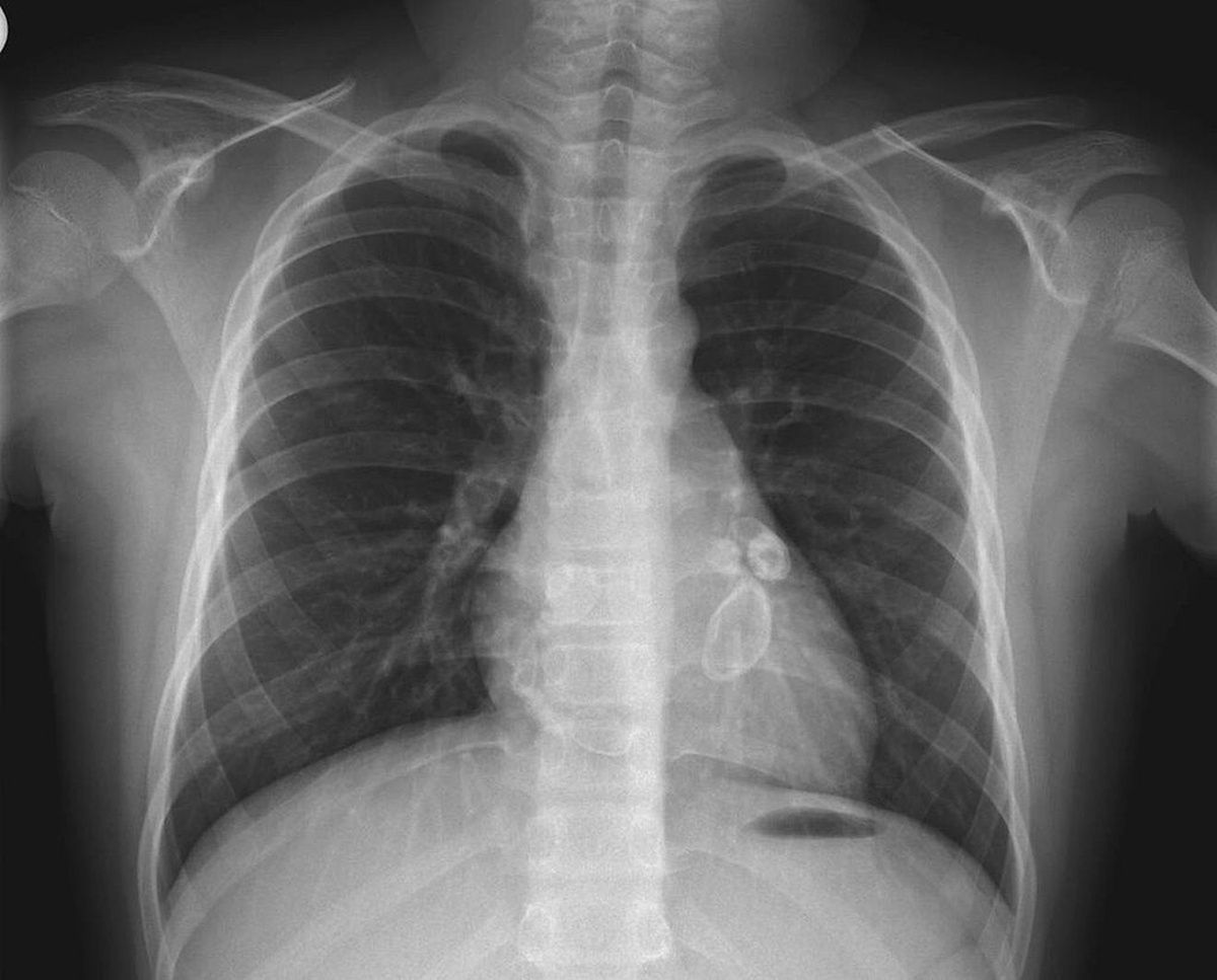 Radiogram klatki piersiowej pacjenta z chorobą Kawasaki. Nowa choroba jest do niej podobna