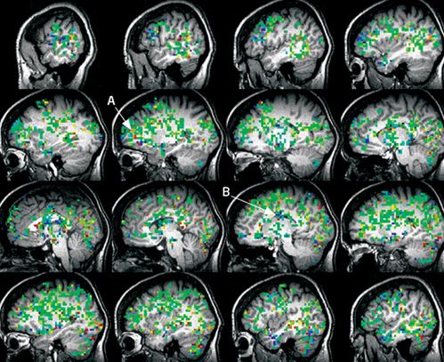 Kobiecy orgazm krok po kroku - literą A oznaczono korę przedczołową, a B... ośrodek bólu (źródło: NewScientist/Barry Komisaruk)