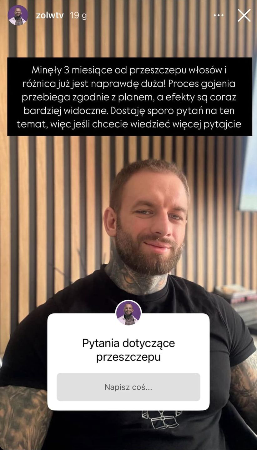 Chłopak Ewel0ny chwali się efektem przeszczepu włosów