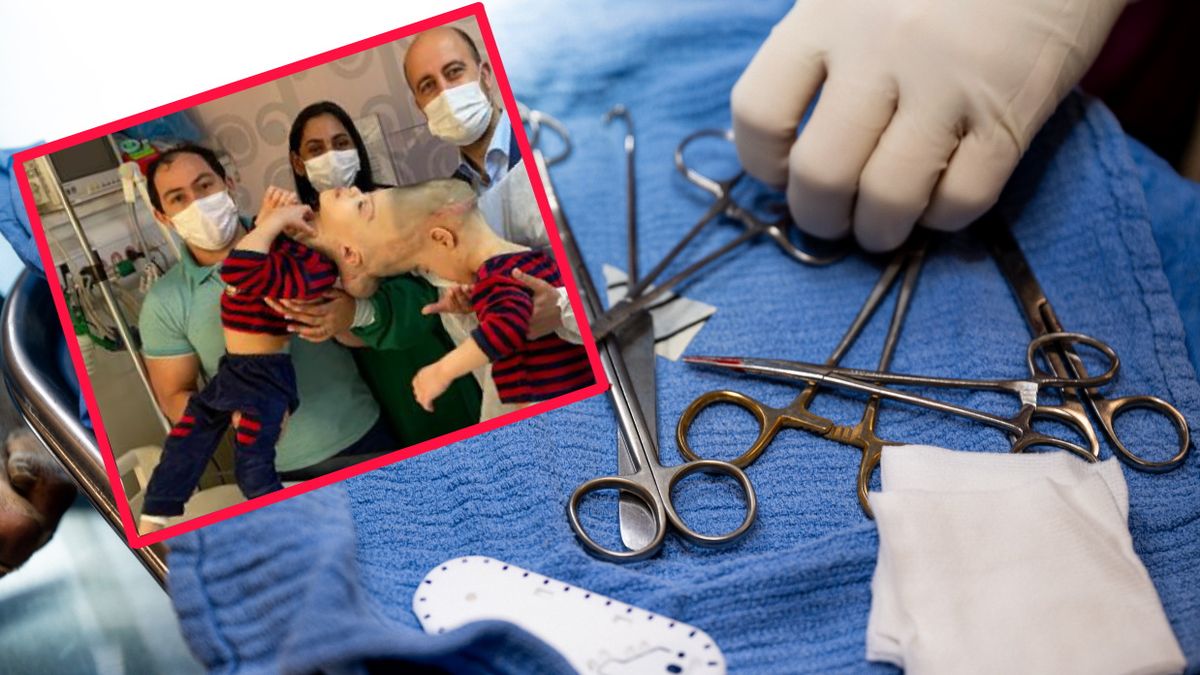 Operacja rozdzielenia bliźniaków trwała 27 godzin