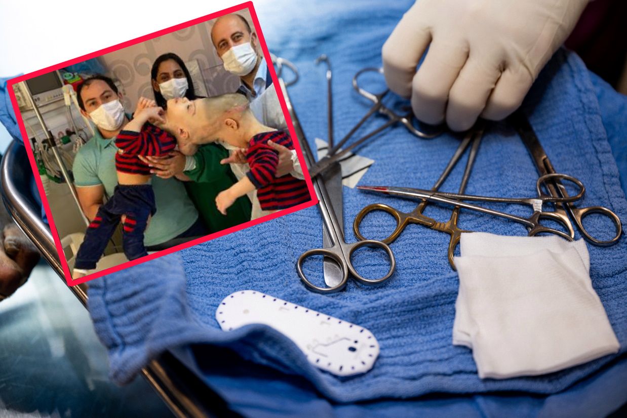 Byli połączeni głowami. Lekarze trzymali się za ręce i modlili