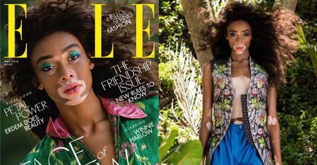 Modelka z bielactwem w tropikalnej sesji dla "Elle"