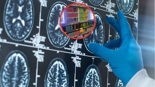 Udar po nadużywaniu popularnego napoju. Lekarze opisują przypadek