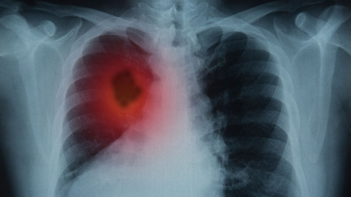 Rak płuc może dawać nietypowe objawy