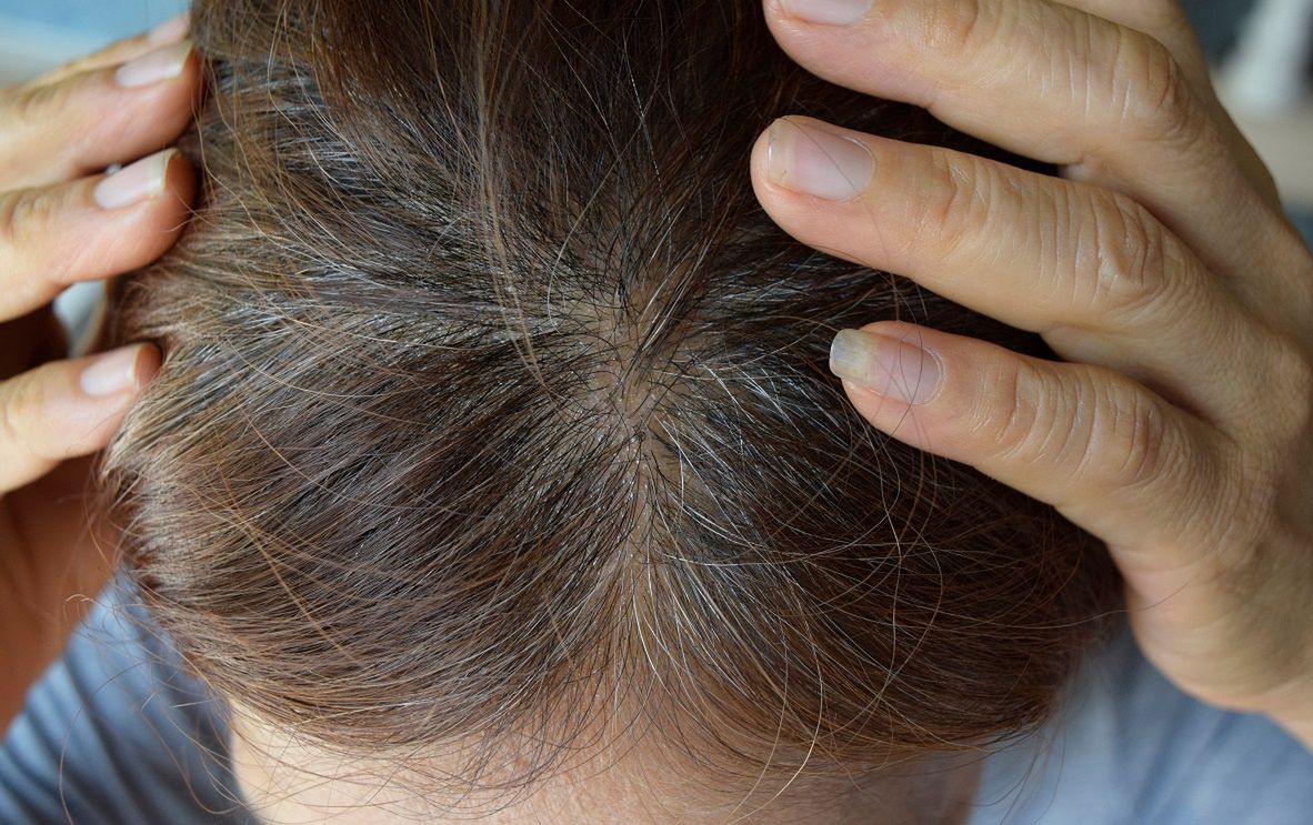 This is how you combat dandruff