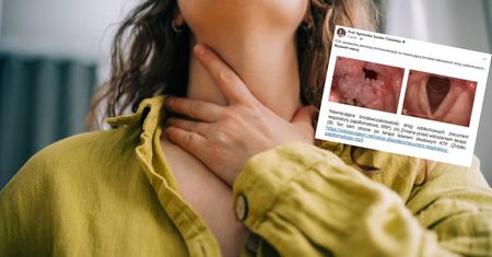Ta rzadka choroba ma związek z HPV. FDA zatwierdza pierwszy lek
