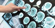Poprawiają pamięć i koncentację. 6 produktów, które chronią przed chorobą Alzheimera