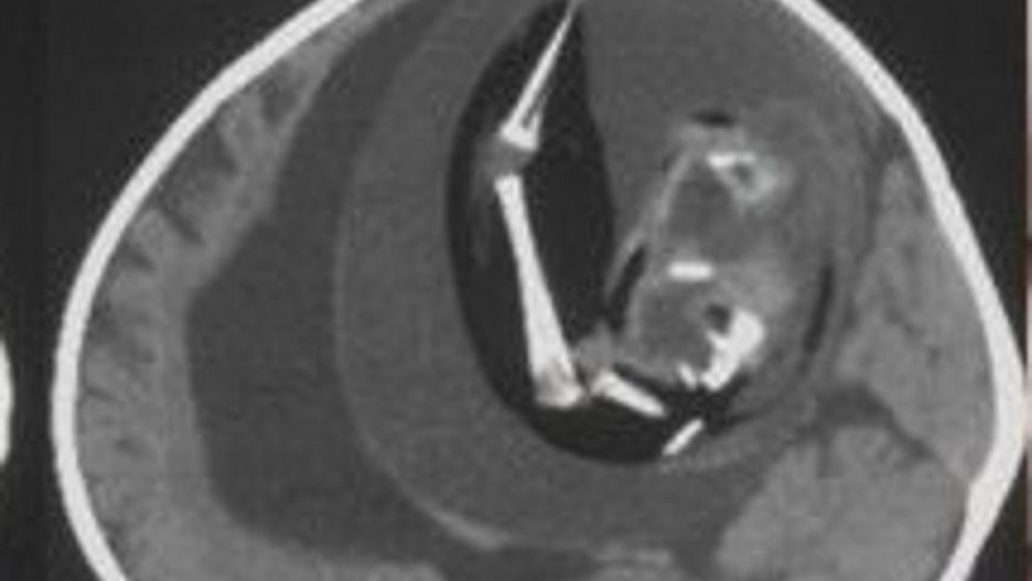 Płód rósł w jej czaszce. Dziewczynka przeszła operację