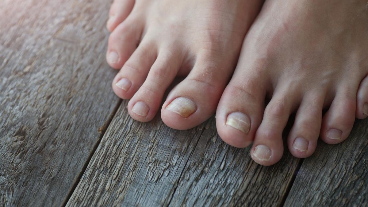 Wysoki cholesterol to podstępny wróg zdrowia. Jego objawy mogą pojawić się na paznokciach stóp