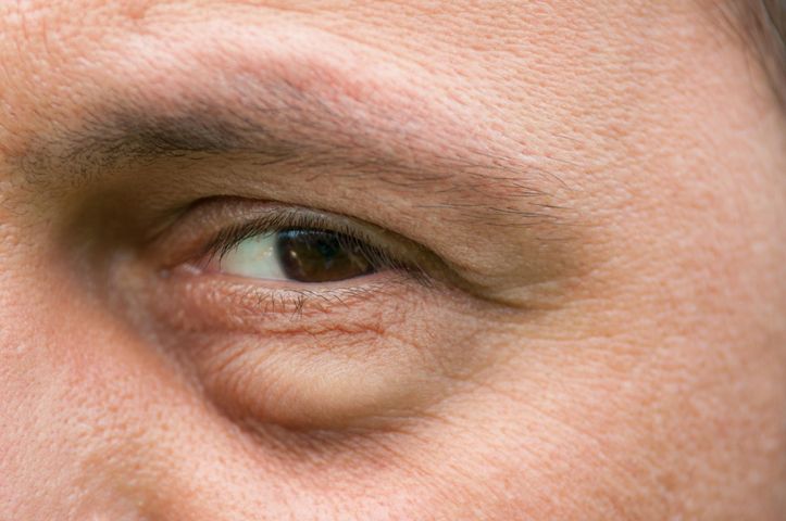 Podkrążone oczy mogą świadczyć o wielu chorobach
