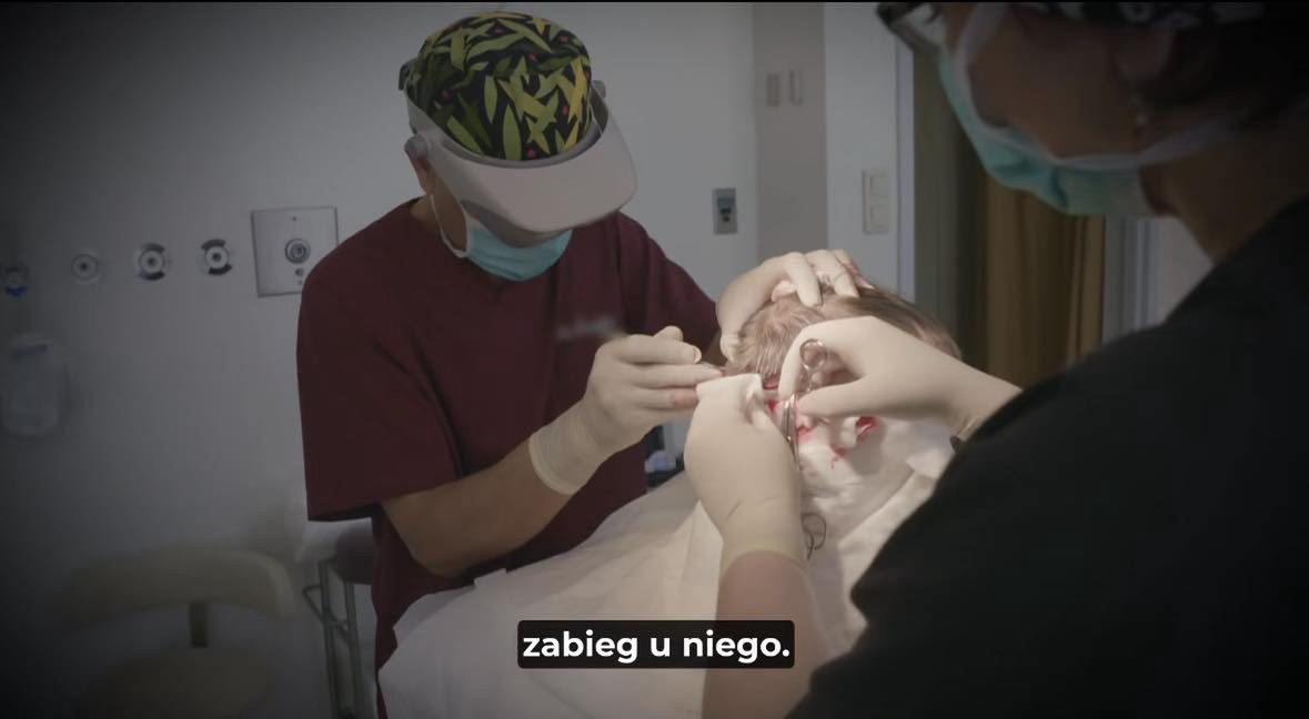 Poddali się przeszczepowi włosów w polecanej klinice
