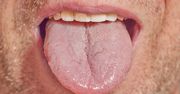 Uważaj. Pojawia się na języku, zwiastuje chorobę