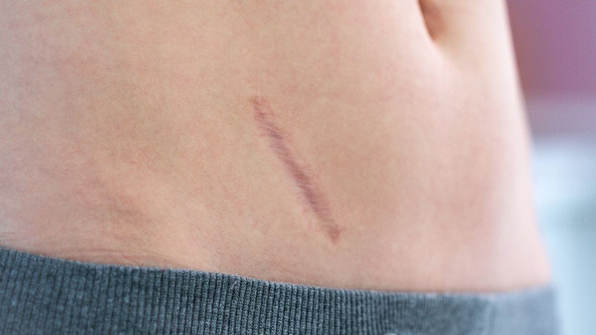 Usunięcie wyrostka robaczkowego może przebiegać w sposób laparoskopowy lub klasyczny.