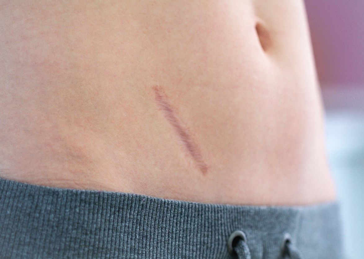 Usunięcie wyrostka robaczkowego (appendektomia) - przebieg laparoskopii, efekty uboczne zabiegu