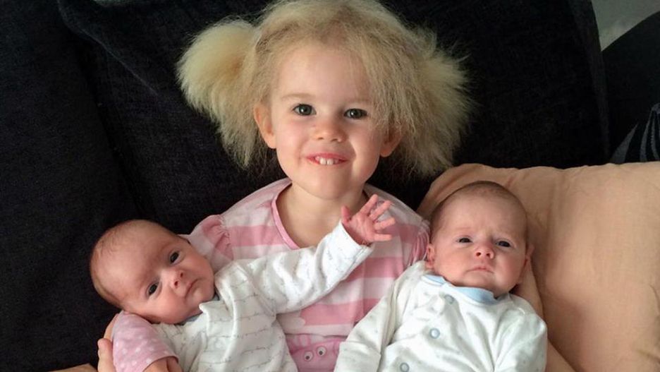 Zespół włosów niedających się uczesać [PA Real life]