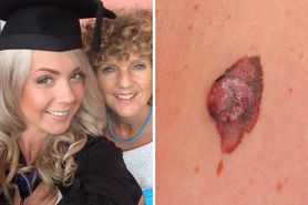 Smarowała skórę olejem spożywczym. Agresywny nowotwór okazał się nie do opanowania