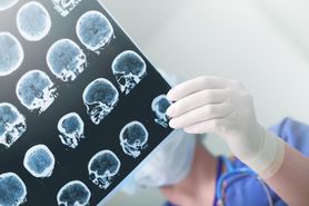 NIK: Aż jedna trzecia pacjentów z podejrzeniem udaru mózgu trafia na nieodpowiedni oddział