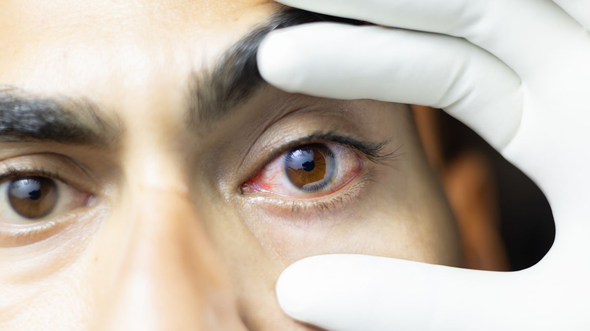 Eye Flue
wide open eye of an Indian Man suffering from conjunctivitis or eye flue.
Uma Shankar sharma
colour image, extreme close up, virus organism
