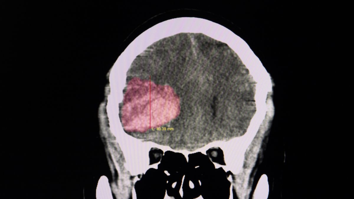 Zdjęcie mózgu pacjenta z widocznym zakrzepem