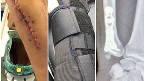 Trwa rekonwalescencja Nickiego Pedersena. Zawodnik już bez gipsu