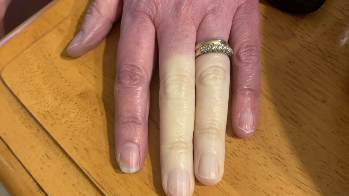 Objaw Raynauda