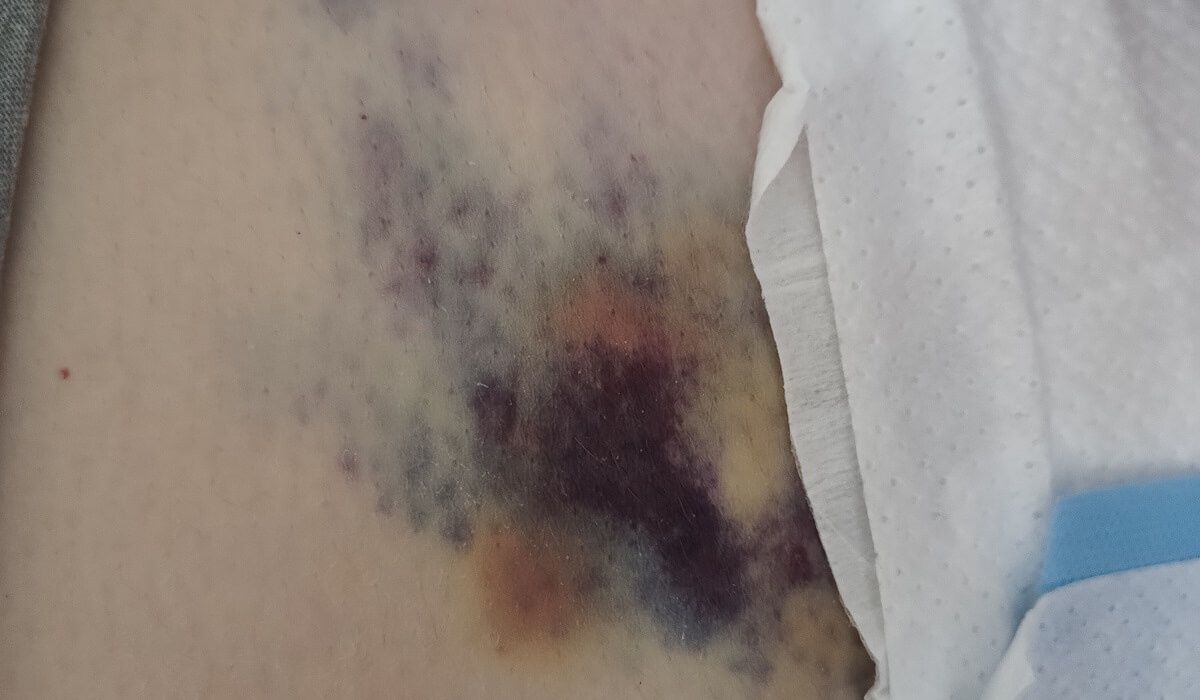 Tak były podawane zastrzyki Clexane
