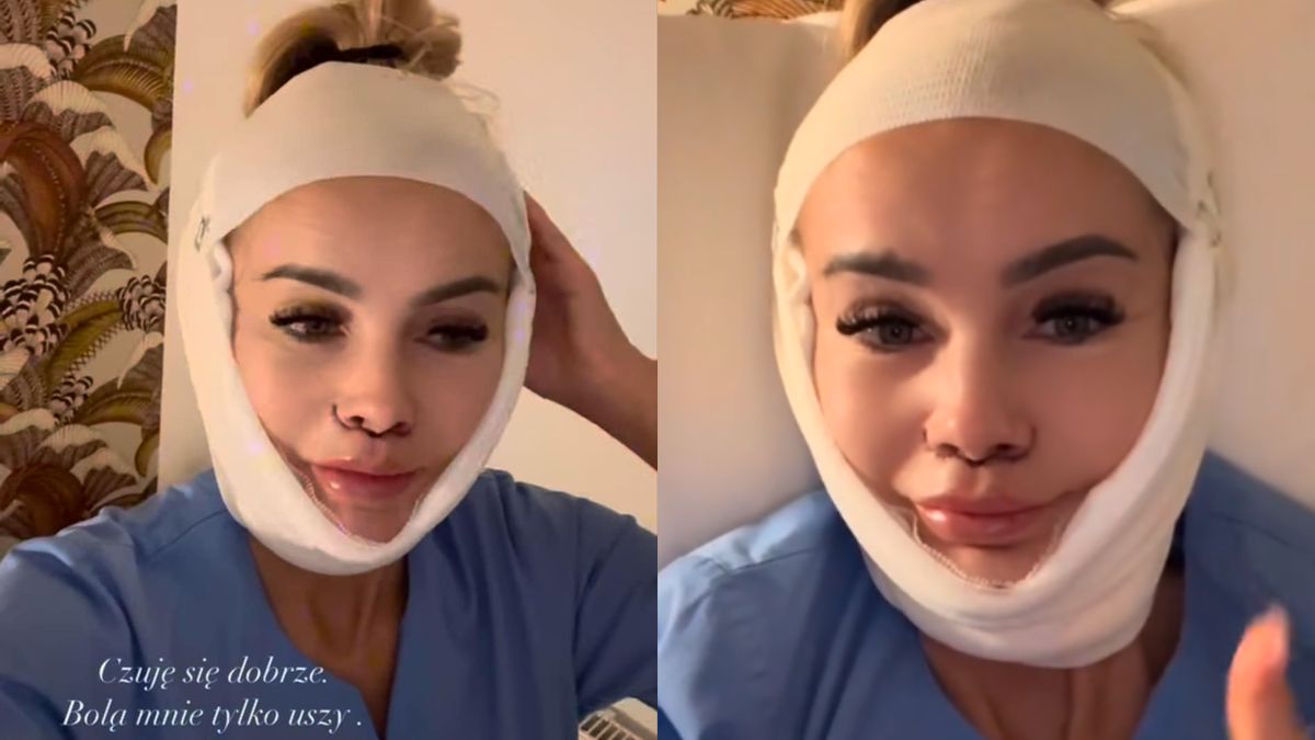 Monika Chwajoł poszła pod nóż. Pochwaliła się efektami