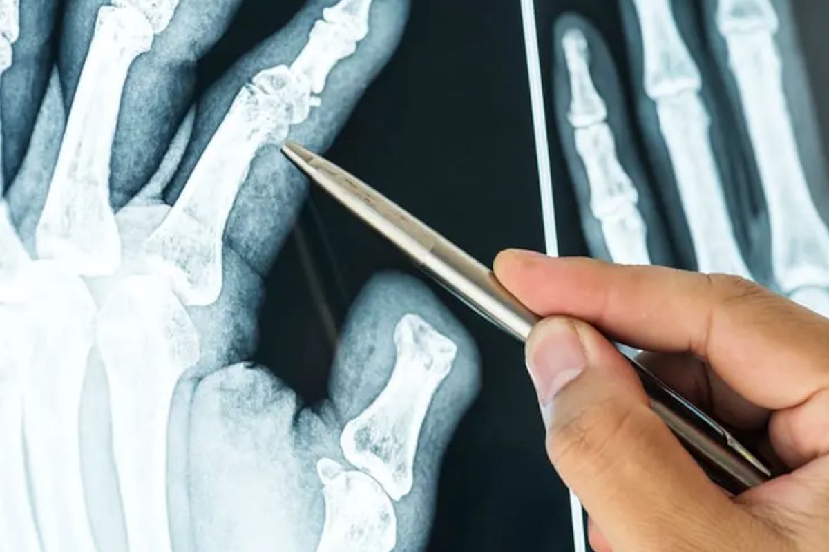 AI tools set to enhance fracture diagnosis in NHS hospitals