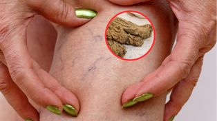 Rozrzedzają krew, "wypłukują" trójglicerydy. Jedz, by odetkać żyły