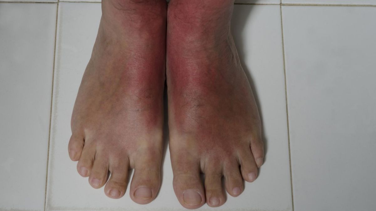 Poparzenia słoneczne zwiększają ryzyko czerniaka. Już kilka takich poparzeń w dzieciństwie znacznie zwiększa ryzyko czerniaka w dorosłym wieku