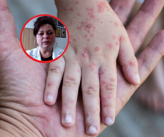 Zapomniana choroba atakuje w Polsce. Wirusolog przestrzega: będą epidemie wyrównawcze