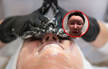"Bubble face" podbija internet. Lekarz ostrzega: Pojawiają się deformacje i guzy